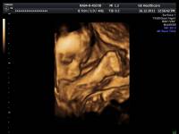 25. týždeň tehotenstva - sono 3D