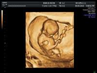 11. týždeň tehotenstva - sono 3D