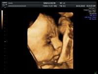 26. týždeň tehotenstva - sono 3D